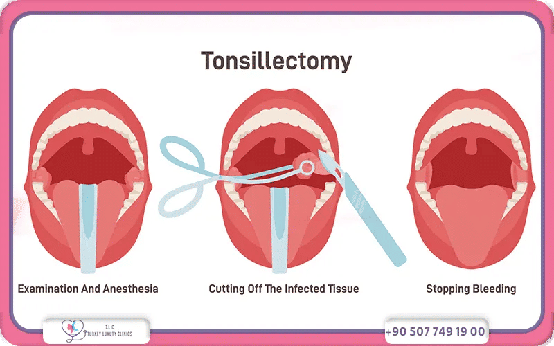 How Much Does a Tonsillectomy Cost? 2026 Prices
