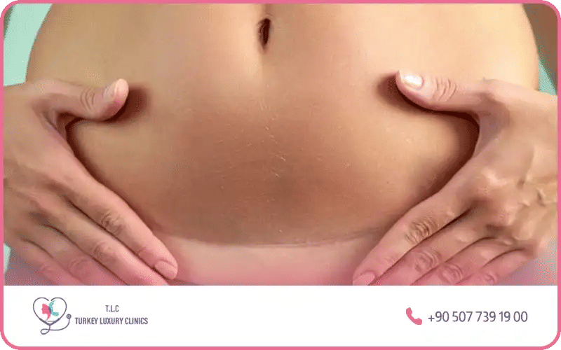 شد البطن مع الولادة القيصرية بالصور