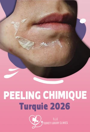 Peeling chimique en Turquie 2026 : Traitement, prix et résultats