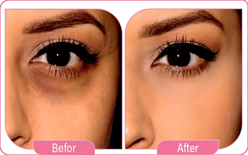 laser cernes avant / après