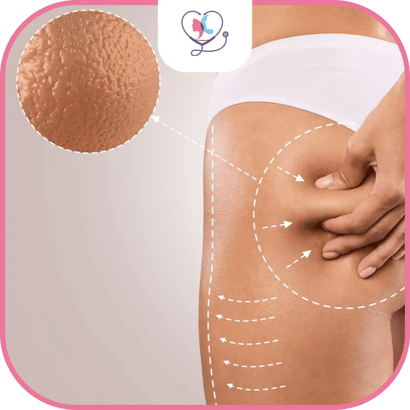 عملية شد ورفع المؤخرة في تركيا