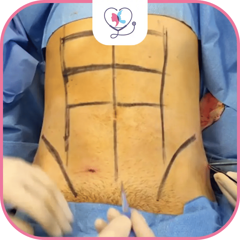 تقنيات الشفط المستخدمة في عملية Six-Pack