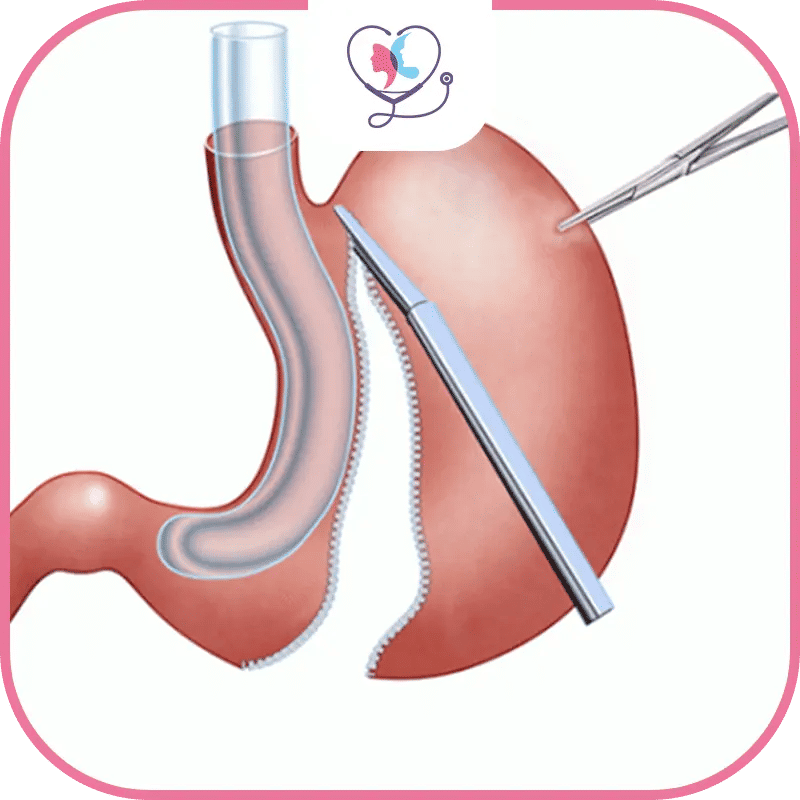 جراحة تصحيح تكميم المعدة