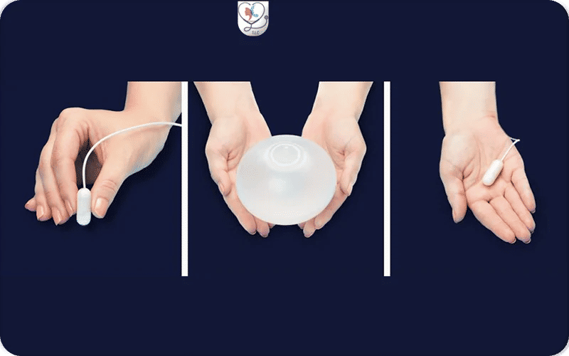 تجربتي مع الكبسولة الذكية: فقدت من 10% إلى 15% من وزني