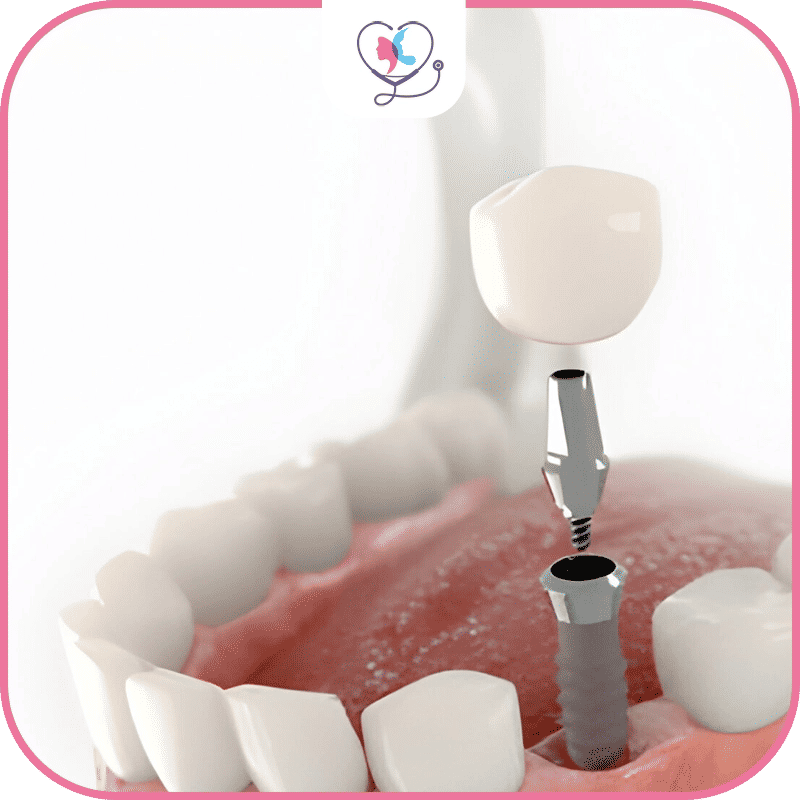 Risques et avantages des implants dentaires en cas de perte osseuse