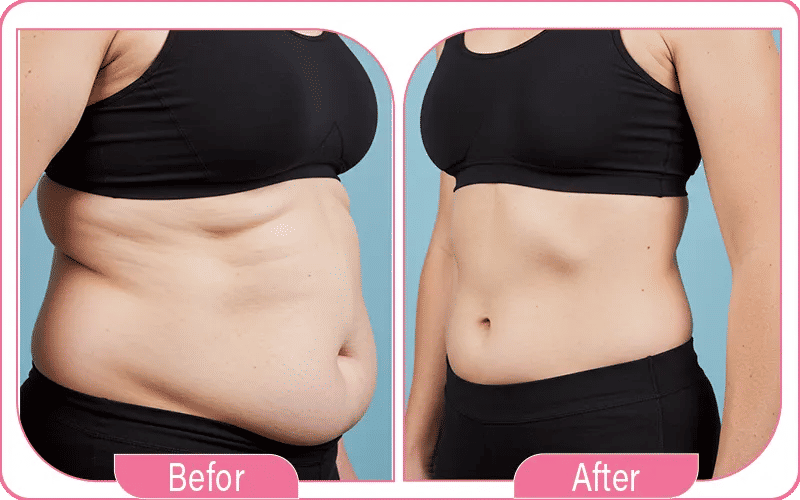 Excess Skin Removal Surgery Before and After