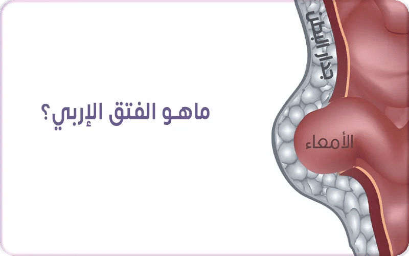 ماهو الفتق الإربي؟