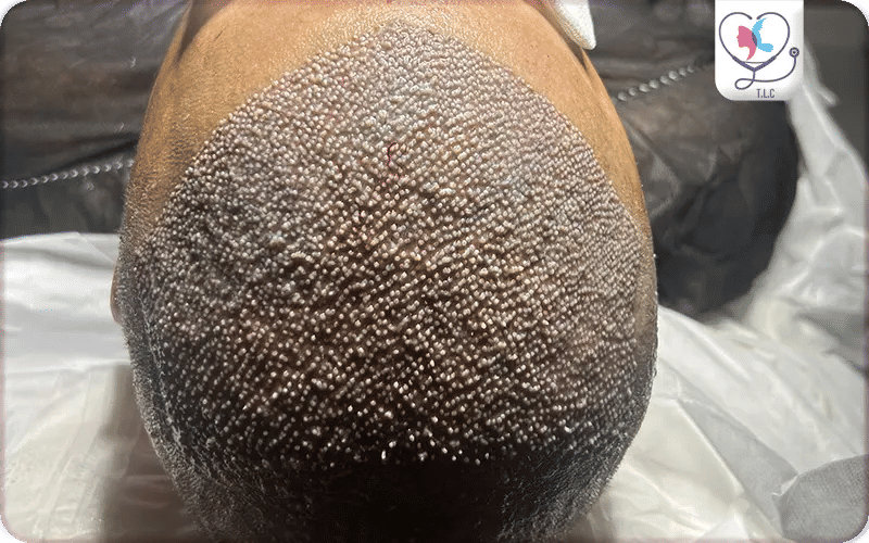 Hair Transplant Techniques in Mexico vs.Turkey