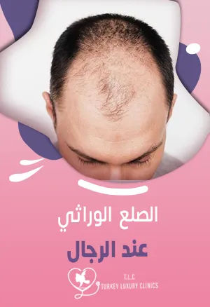 الصلع الوراثي عند الرجال: بدايته وتطوره وعلاجه
