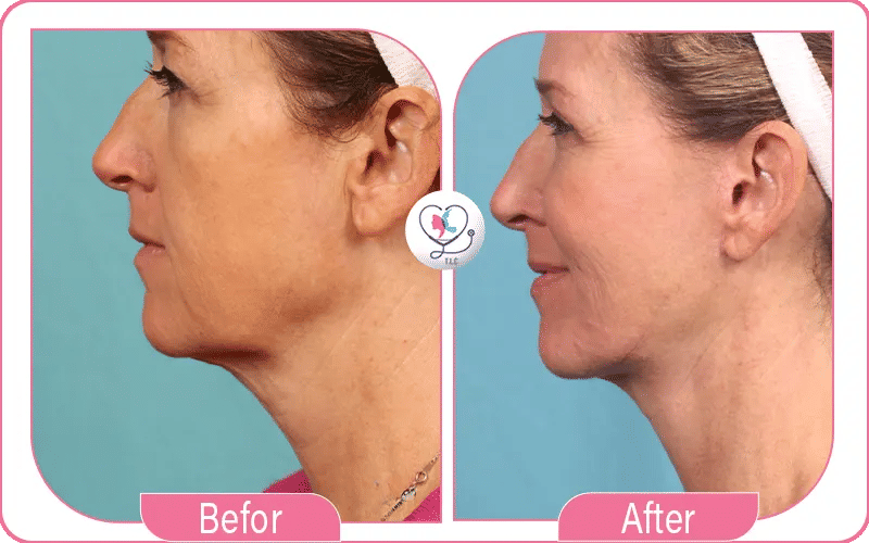 How Much Does a Double Chin Lift Cost?