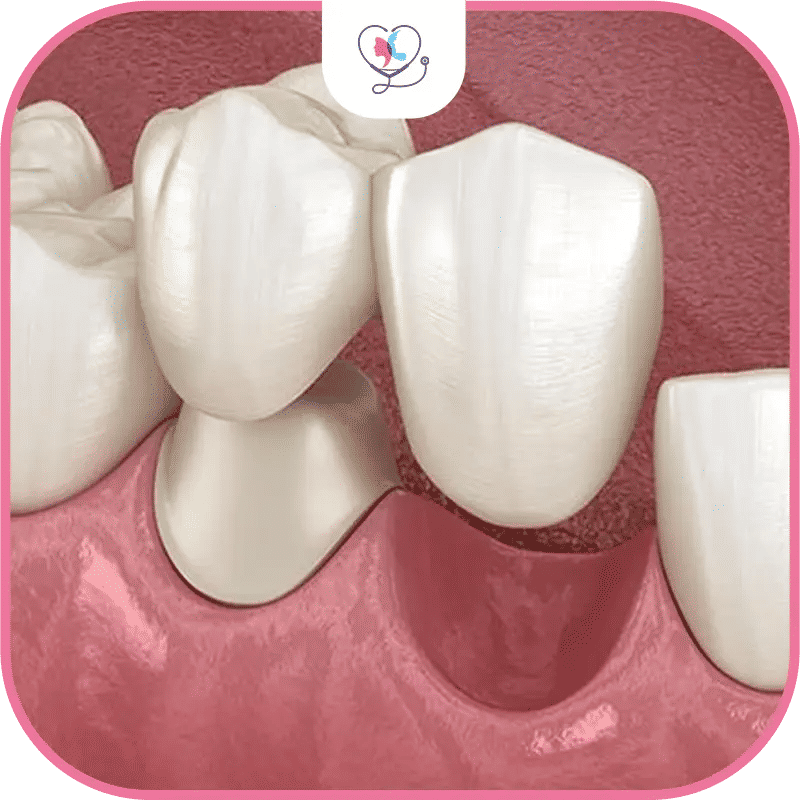 4. Le bridge dentaire 3 dents