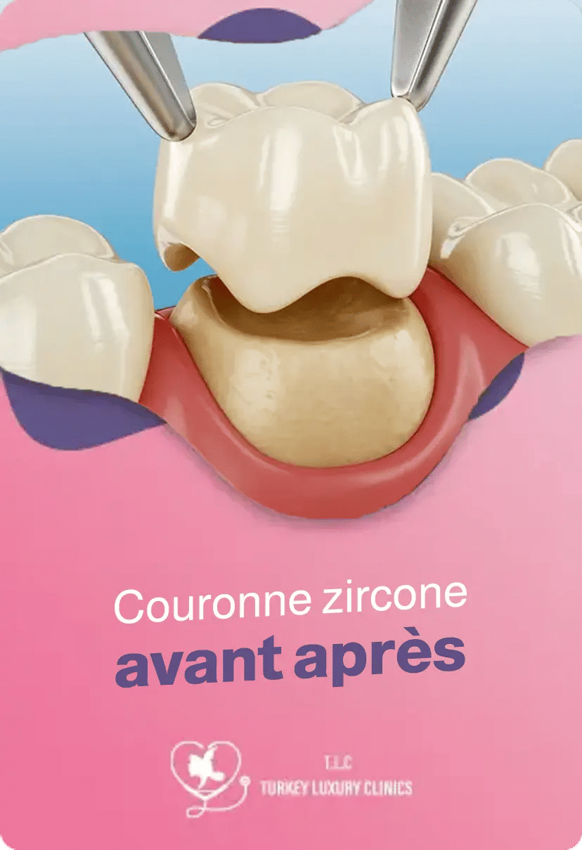 Couronne zircone avant après : transformation du sourire photos et résultats