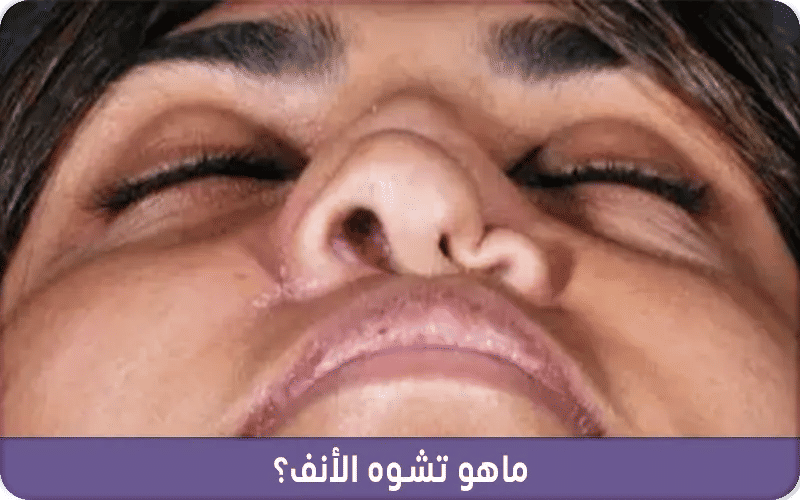 ماهو تشوه الأنف؟