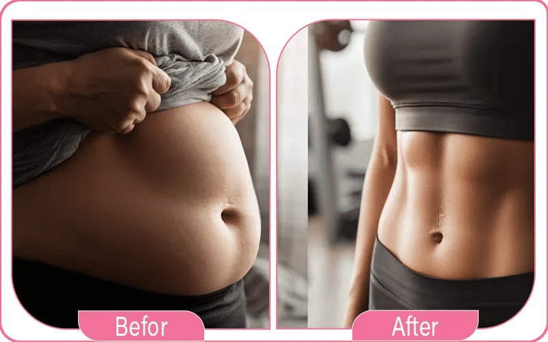 abdominoplastie avant après femme