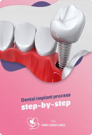 Exploring the dental implant process step-by-step: Your journey to a confident smile