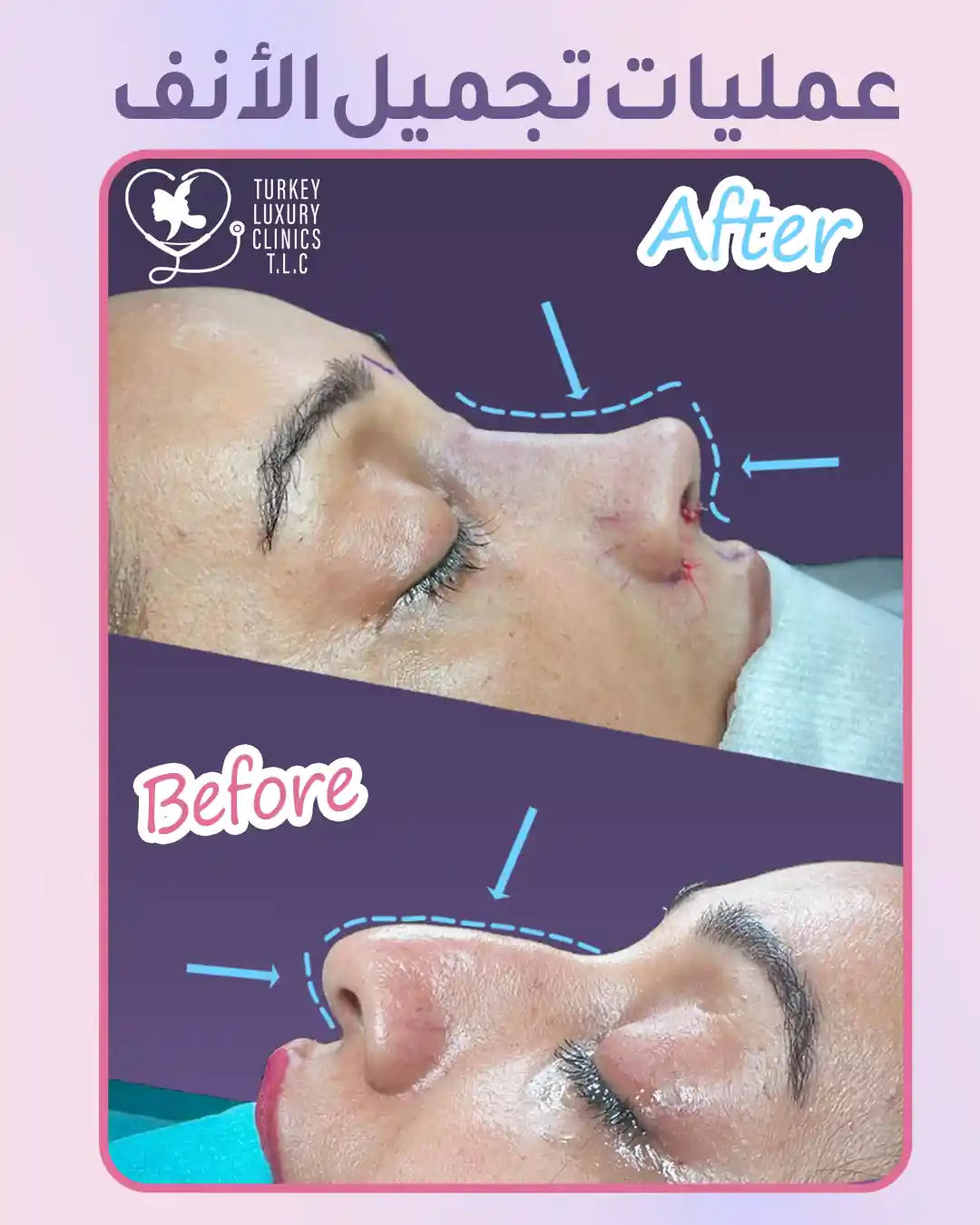 أنواع التخدير في عملية تجميل الانف