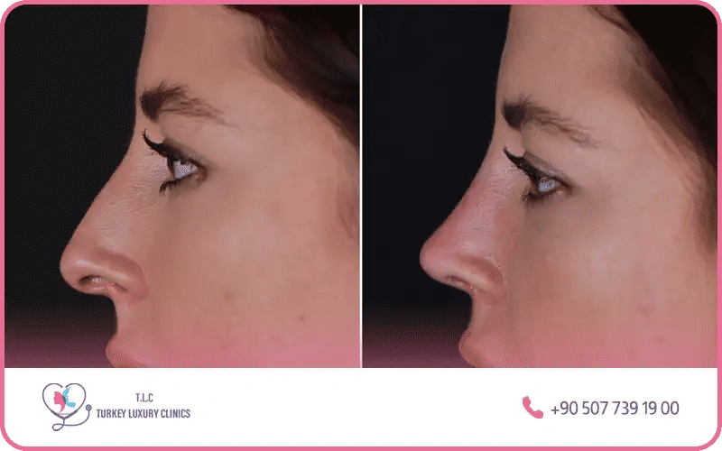 rhinoplastie ultrasonique avant après