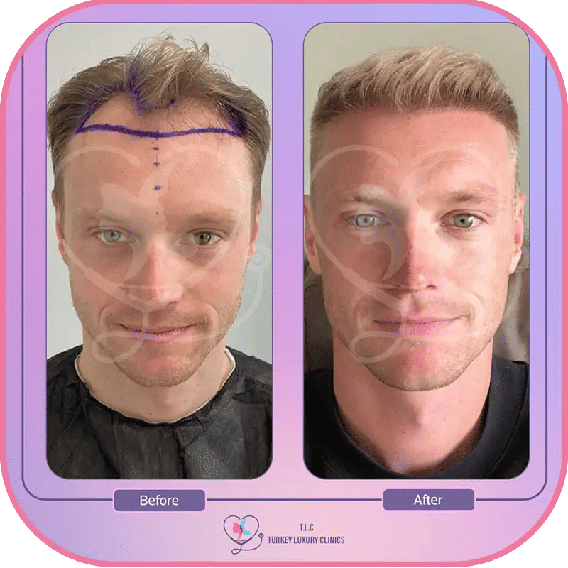 نصائح من تجربتي مع زراعة الشعر في تركيا