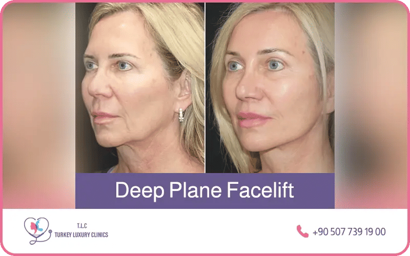 Lifting facciale Deep Plane in Turchia prima e dopo – risultati di ringiovanimento facciale duraturo presso Turkey Luxury Clinics Istanbul