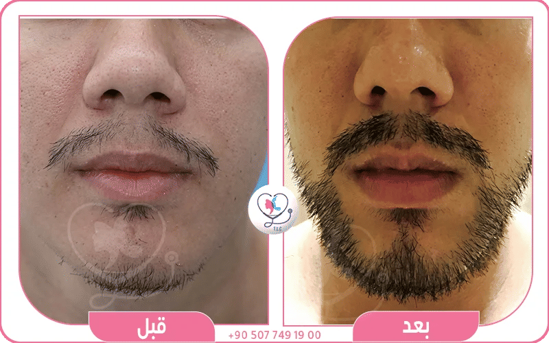 نتائج زراعة شنب قبل وبعد