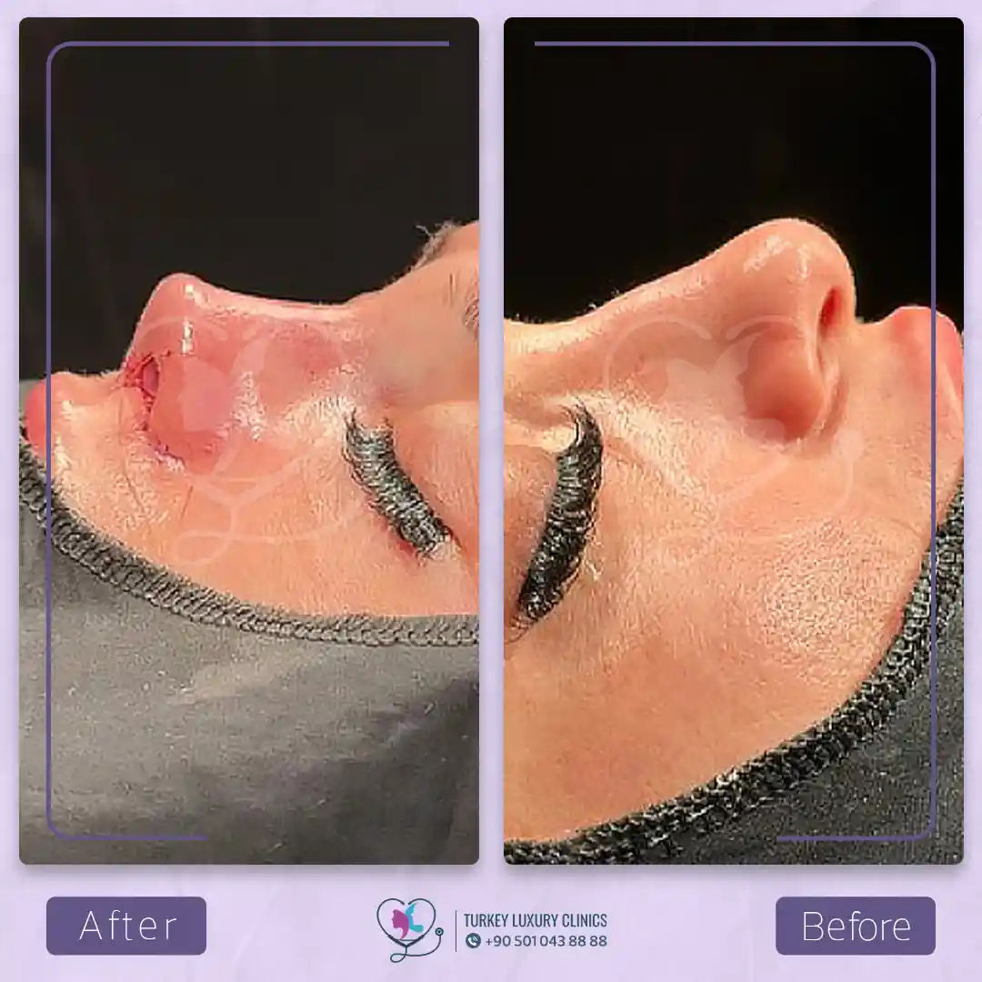 متى يظهر الشكل النهائي للأنف بعد عملية التجميل؟