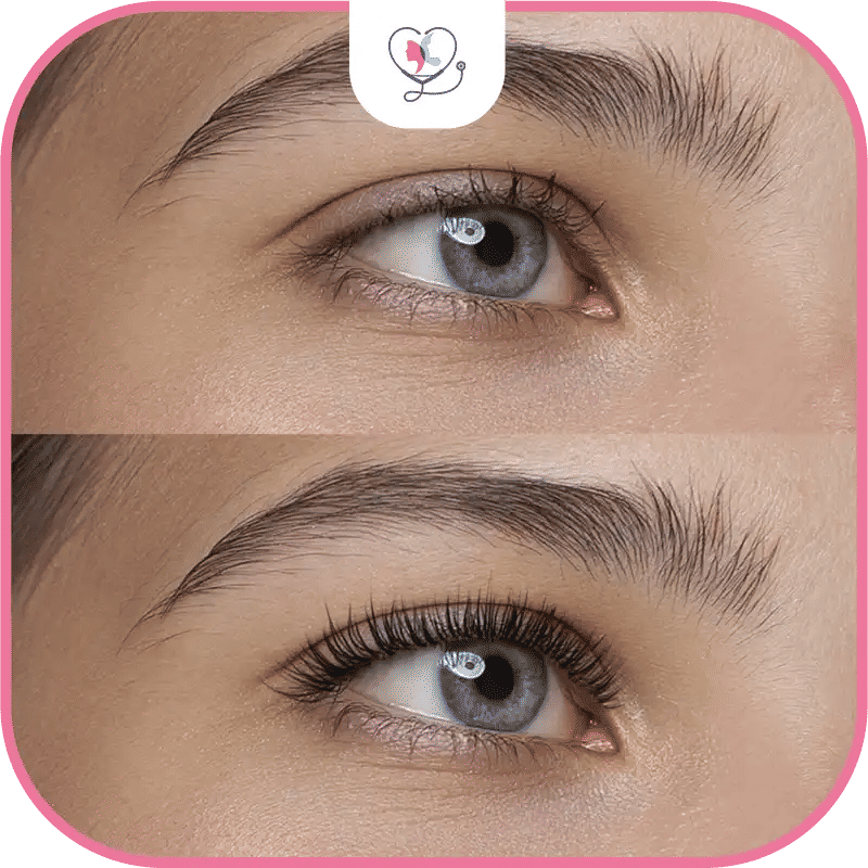 What is Eyelash Transplant?