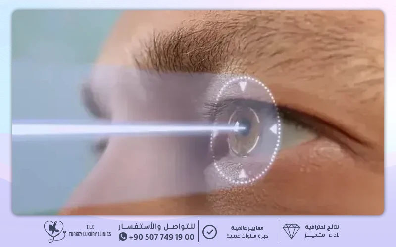 القرنية المخروطية والليزك