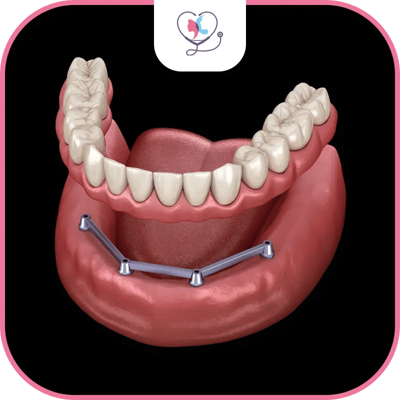 All on 4 Dental Implant in Turkey