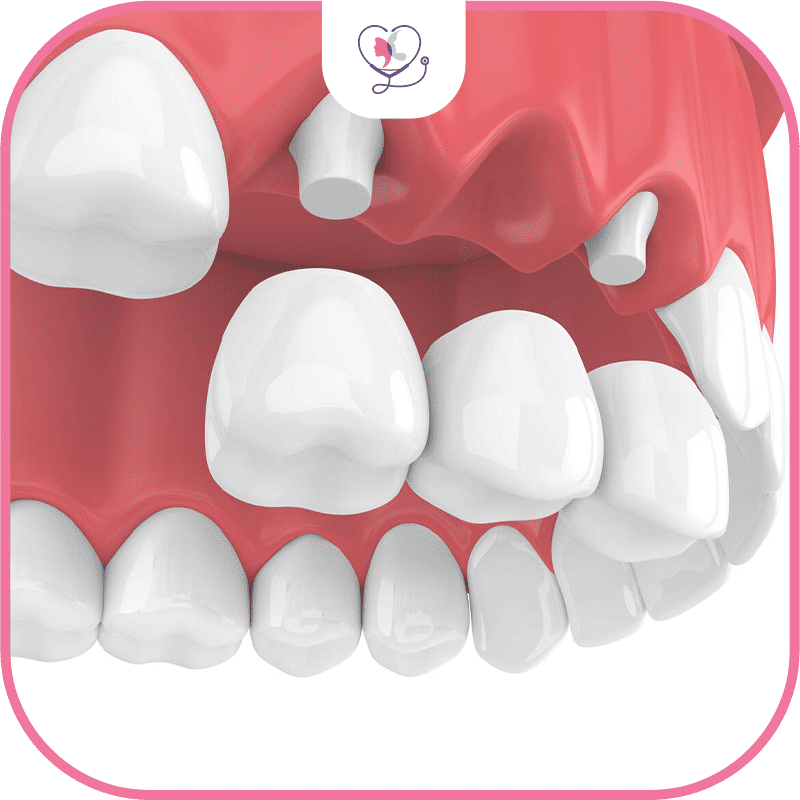 bridge dentaire fixe - amovible