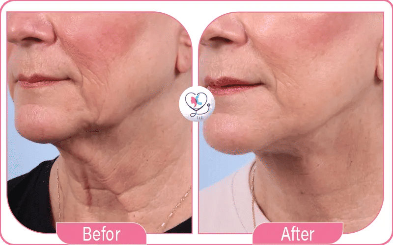 Swelling Photos During Neck Lift Recovery