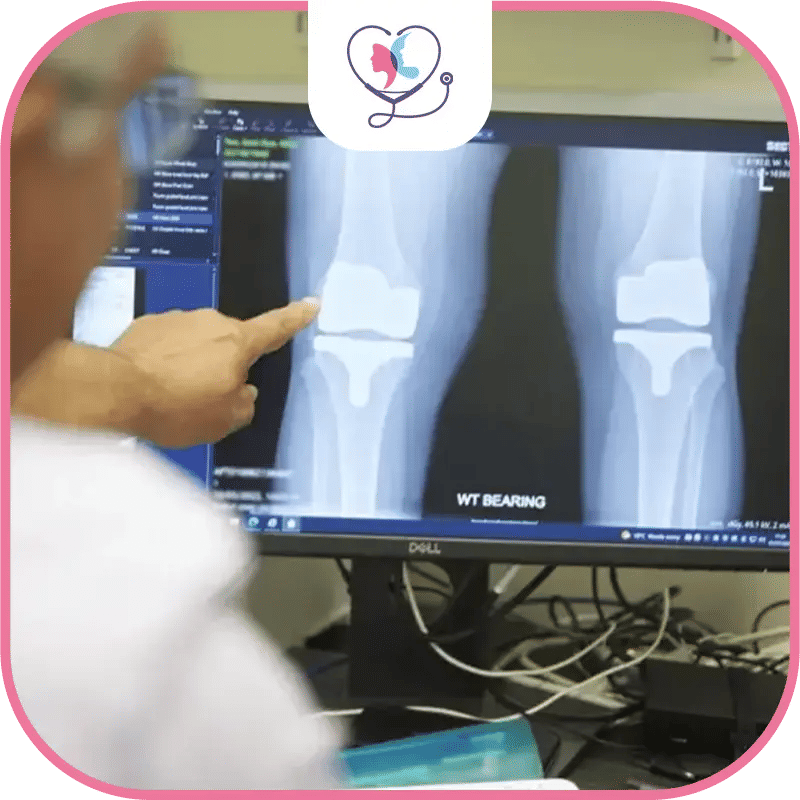 Meilleurs chirurgiens de l'arthroplastie du genou en Turquie