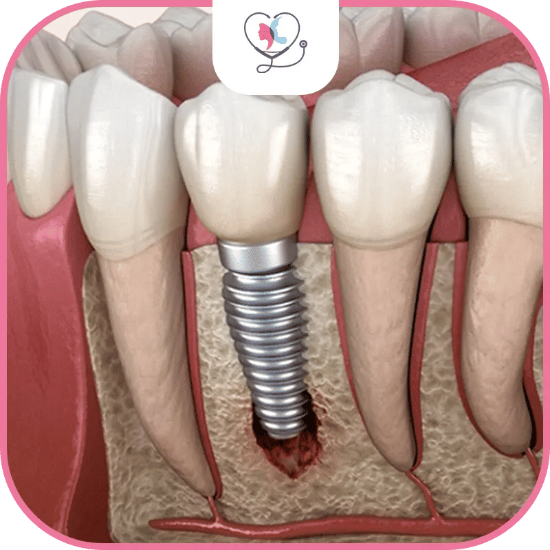 فشل زراعة الأسنان