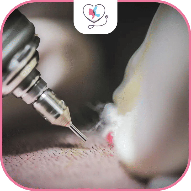 تقنية البيركوتان لزراعة الشعر