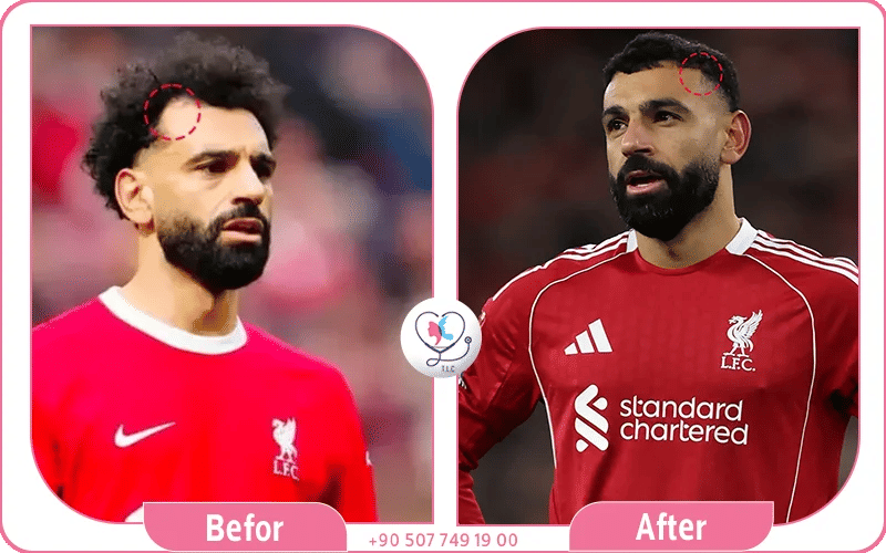 زراعة شعر محمد صلاح قبل وبعد بالصور