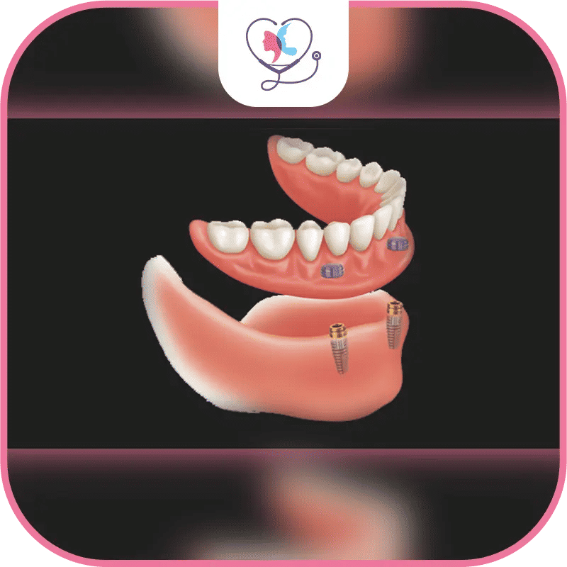 أنواع زراعة الأسنان في تركيا