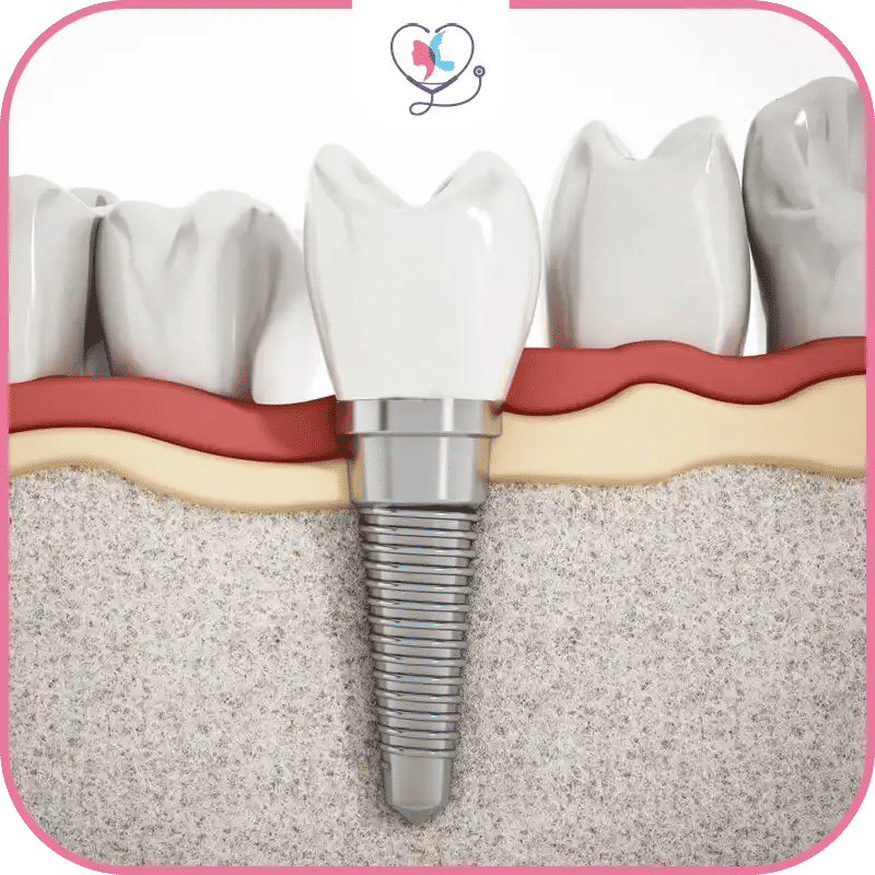 Why Should You Choose Dental Implants Over Other Treatments?