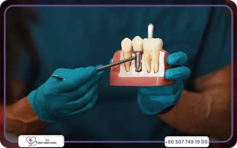 مضاعفات تأخير زراعة الأسنان بعد الخلع