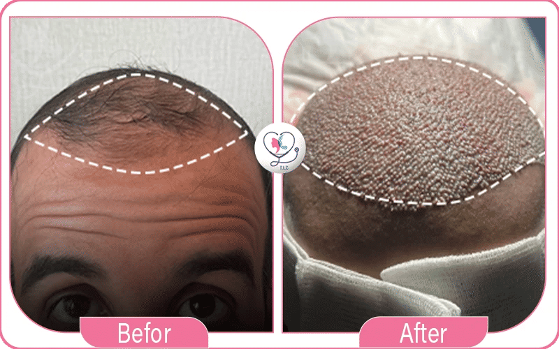 خامساً: التكلفة المنخفضة لزراعة الشعر