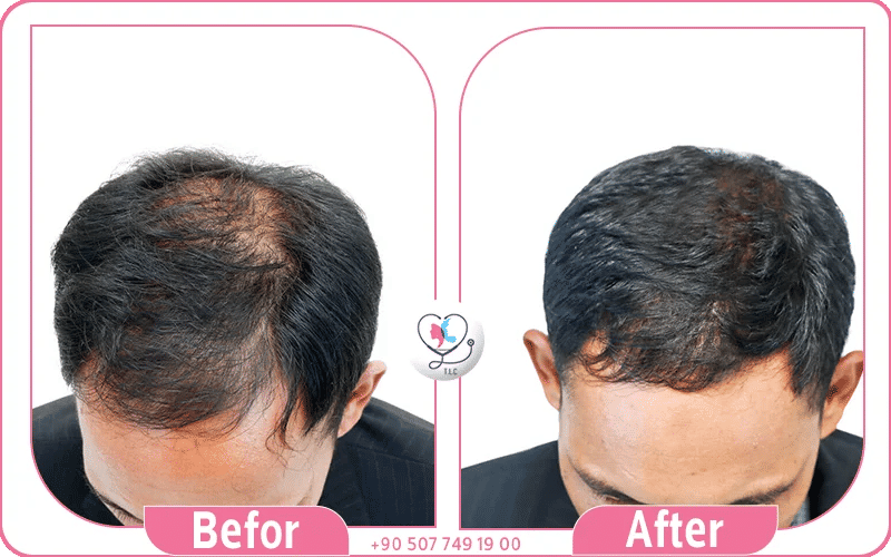 أولاً: الطرق الطبيعية لعلاج فراغات الشعر