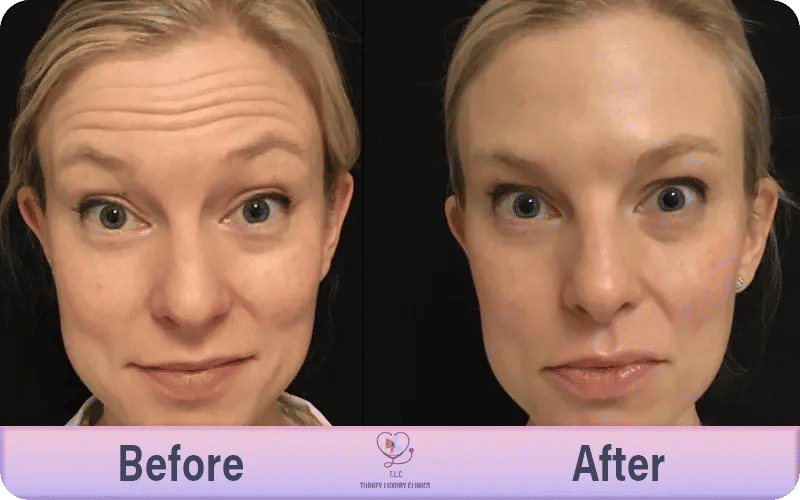 Risks of Incorrect Botox Sites and Points for Brow Lift