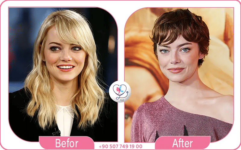 What Plastic Surgery Did Emma Stone Have? 2