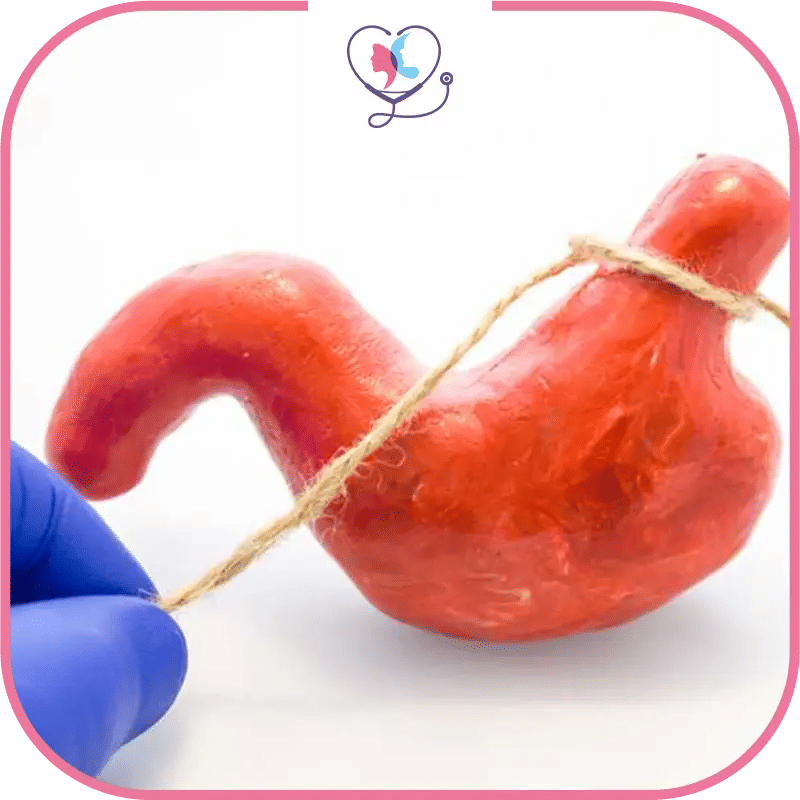 Pourquoi opter pour une alternative non chirurgicale à la sleeve gastrectomie ?