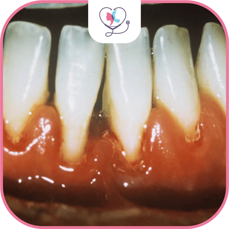 récession gingivale