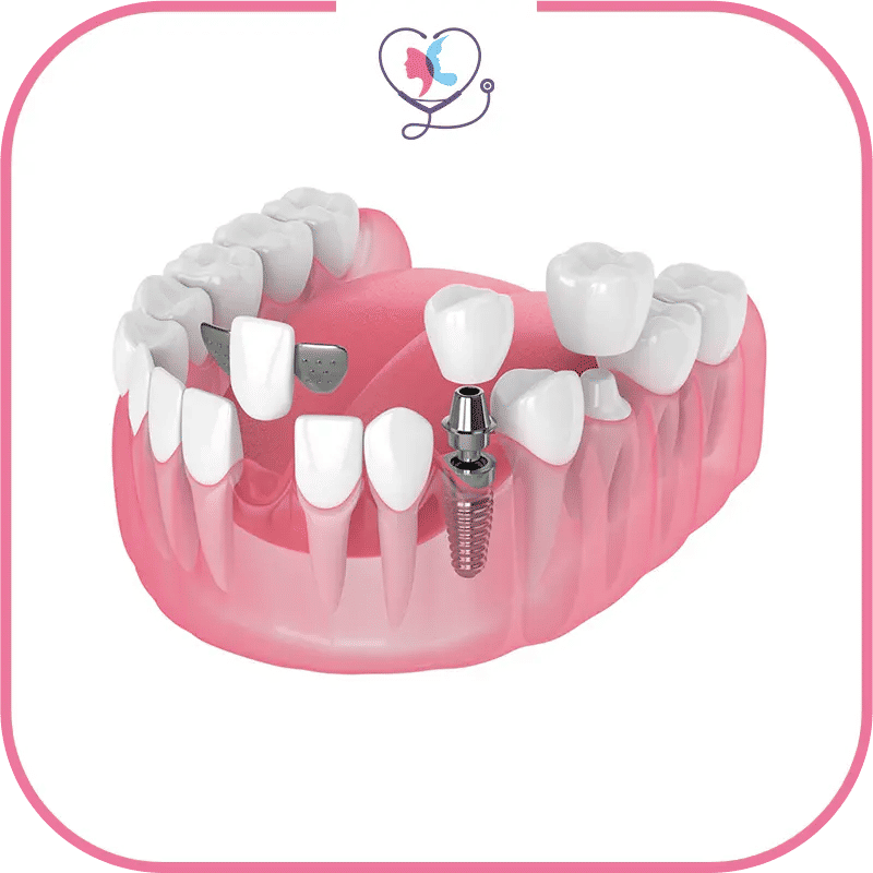 types d'implants dentaires