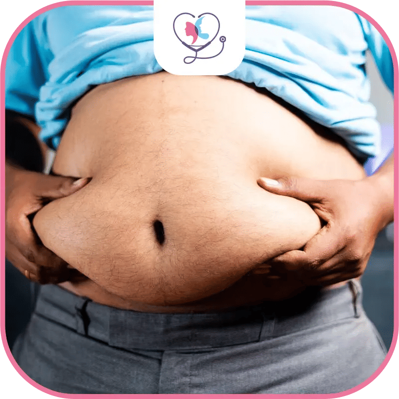  شفط دهون البطن