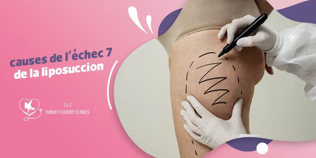 10 causes de l'échec de la liposuccion