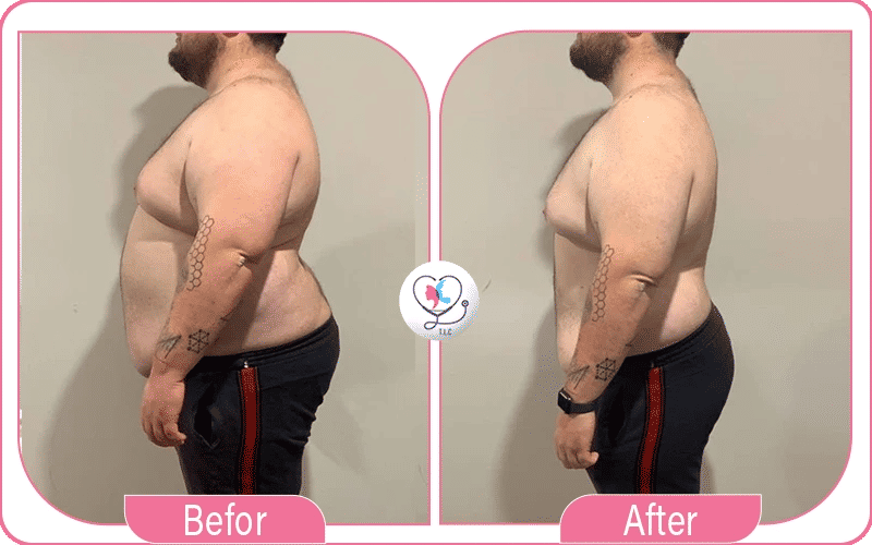 نصائح هامة بعد تكميم المعدة وبالون المعدة