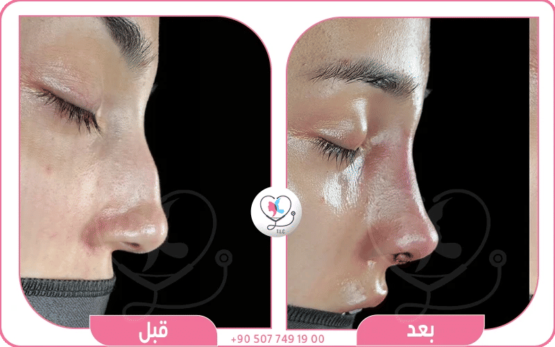  عملية تجميل الأنف