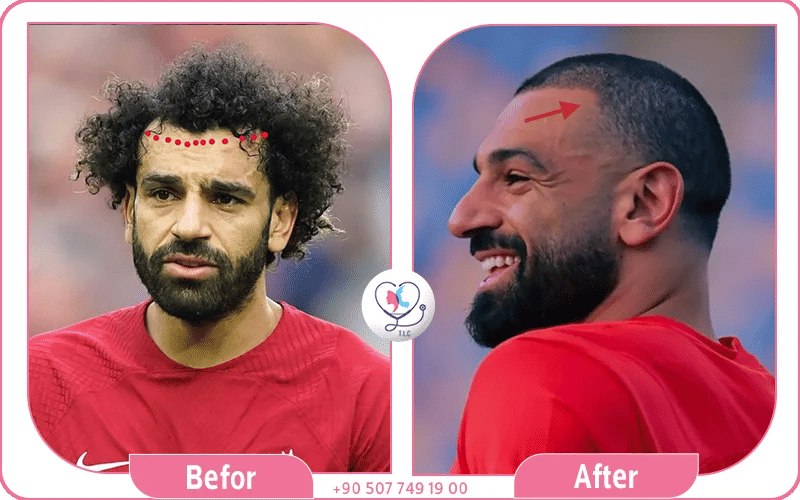 زراعة شعر محمد صلاح قبل وبعد زراعة شعر محمد صلاح قبل وبعد