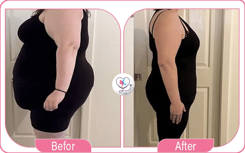 الفرق بين تغيير المسار وقص المعده في المزايا والنتائج